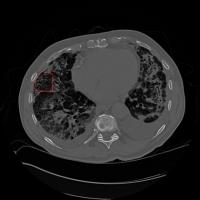 ILD Lung Imagess project thumbnail