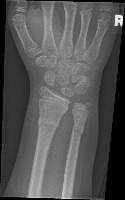 fracture detection project thumbnail