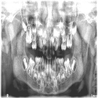 INDIVIDUAL TEETH LABELLING Instance Segmentation Model by PROJECT 1