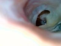 Tympanic-Membrane project thumbnail
