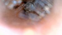 All WAX CERUMEN CASES ENT project thumbnail