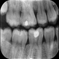 tooth project thumbnail