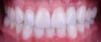 Teeth project thumbnail