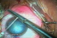 Cataract Severity project thumbnail