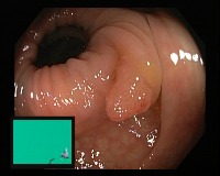 gut disease project thumbnail