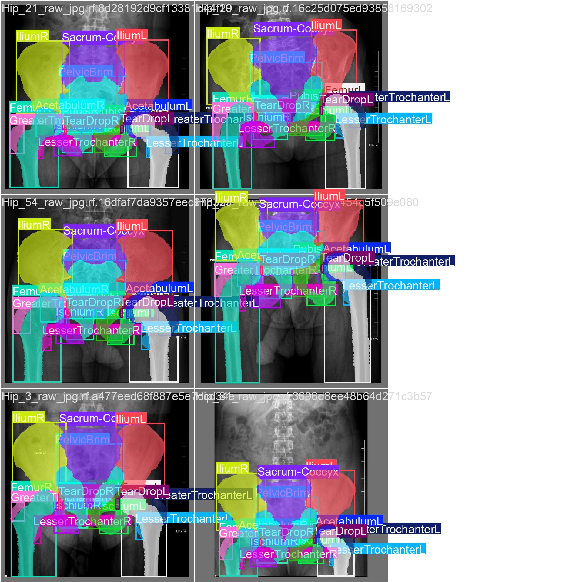 pelvis_xray Instance Segmentation Model by cho
