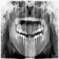 tooth det stage one project thumbnail