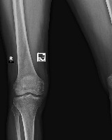 Bone fracture project thumbnail