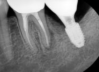Implants project thumbnail