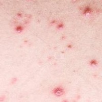 ISIC skin cancer classification project thumbnail