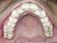 Maxillary project thumbnail