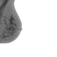 breast-tumor-mammo project thumbnail