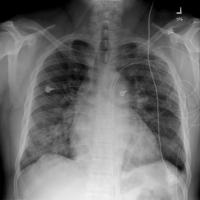 Chest X-Ray_Edema Paru project thumbnail
