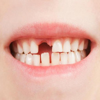 final_teethgap project thumbnail
