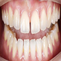 retrain_teeth_gap project thumbnail