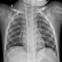CovidNormalPneumonia project thumbnail