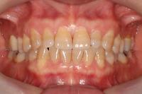 oral disease detection project thumbnail