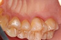 AI-based oral disease detection project thumbnail