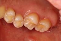 Oral disease project thumbnail