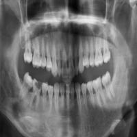 wisdom-teeth-demo project thumbnail