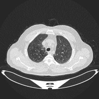 lung cancer project thumbnail