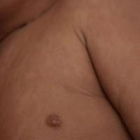 Measles Detection project thumbnail