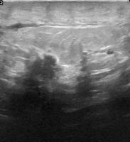 breastcancer project thumbnail
