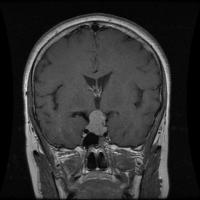 Brain-Tumoe Detection project thumbnail