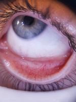 Anemia-Detection project thumbnail