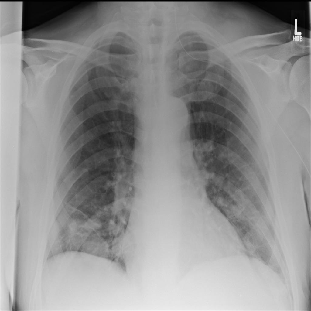 Pneumonia Detection Object Detection Dataset and Pre-Trained Model by ...