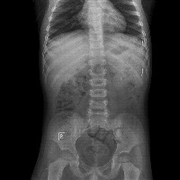 Stone_In_Urinary_System project thumbnail
