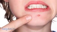 papule project thumbnail