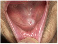 oral cancer project thumbnail