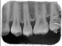 Training Staging Periodontitis project thumbnail