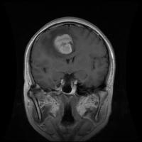 BrainTumorSegmentationv1 project thumbnail