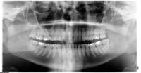 teeth_detect project thumbnail