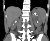 Kidney Stone project thumbnail