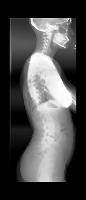 spine_detection_LP project thumbnail