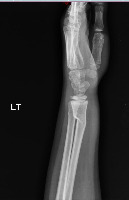 fracture project thumbnail