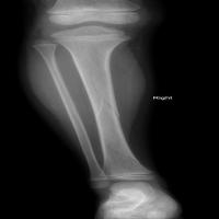 fracture project thumbnail