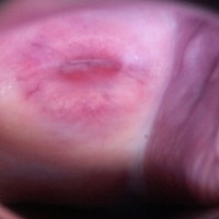 cervical cancer project thumbnail