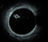 Artery deformations detection project thumbnail