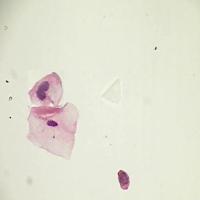 cancer-detection-v1 project thumbnail