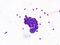 Cancer_cells project thumbnail