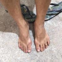 foot ulcer project thumbnail