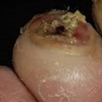 foot ulcer project thumbnail
