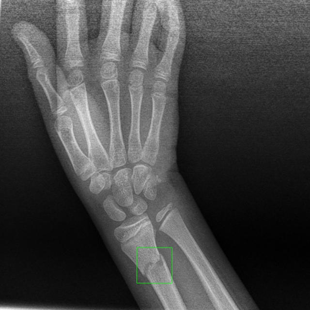 bone fracture Classification Dataset by bone broken