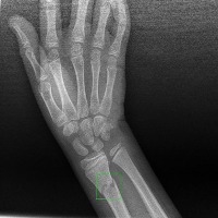 bone fracture project thumbnail