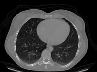 Lung_cancer project thumbnail