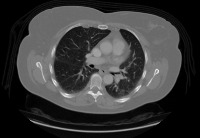 lung_cancer_model project thumbnail